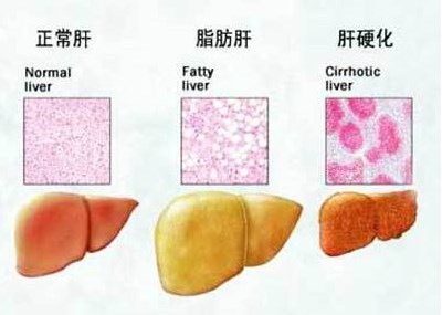 全自動生化儀分析脂肪肝是吃得太油膩嗎—山東國康
